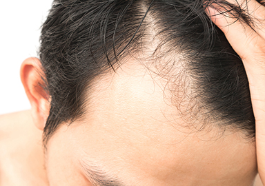 Greffe Capillaire pointe-à-pitre ivg guadeloupe